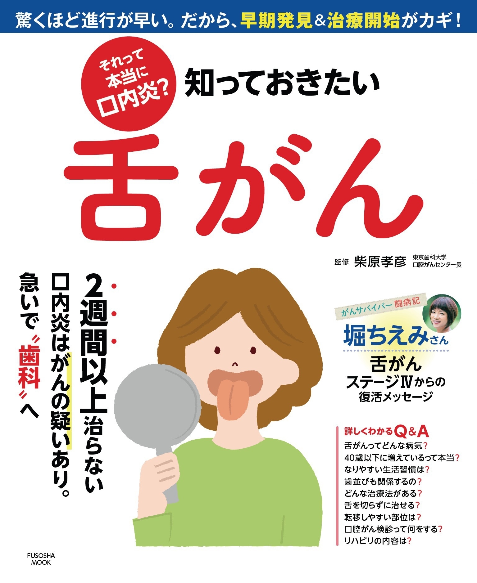 それって本当に口内炎? 知っておきたい舌がん