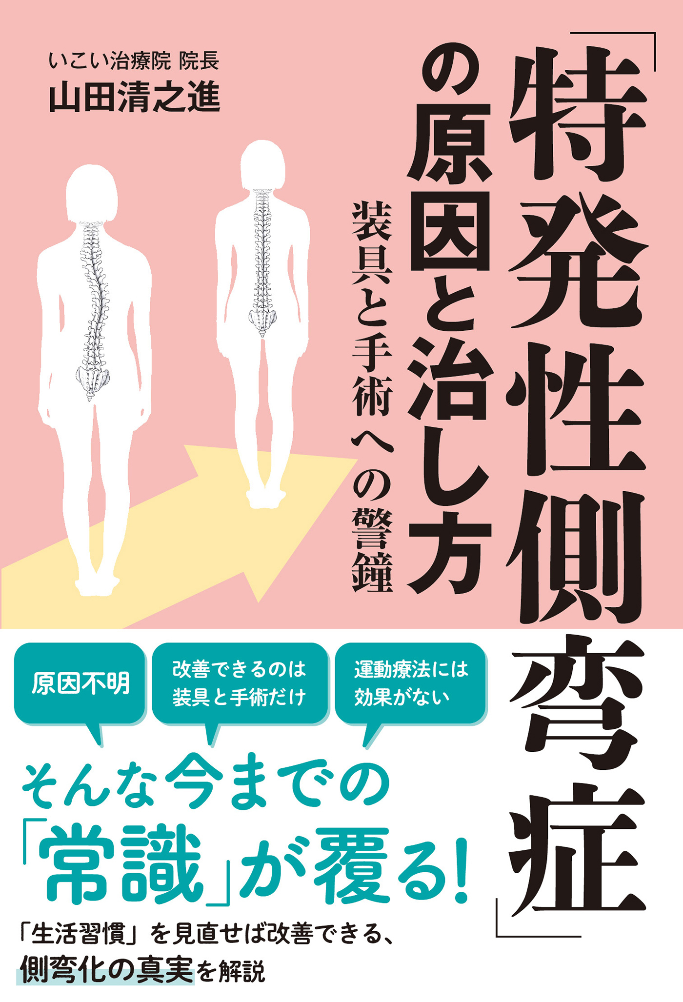 「特発性側弯症」の原因と治し方