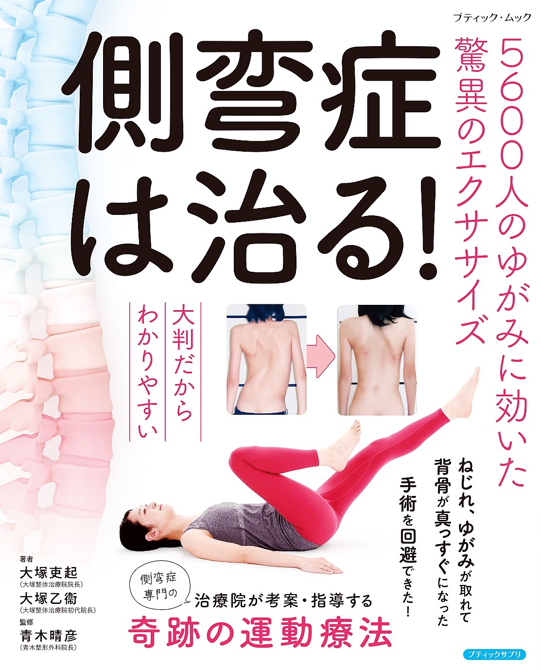 側弯症は治る！5600人のゆがみに効いた驚異のエクササイズ