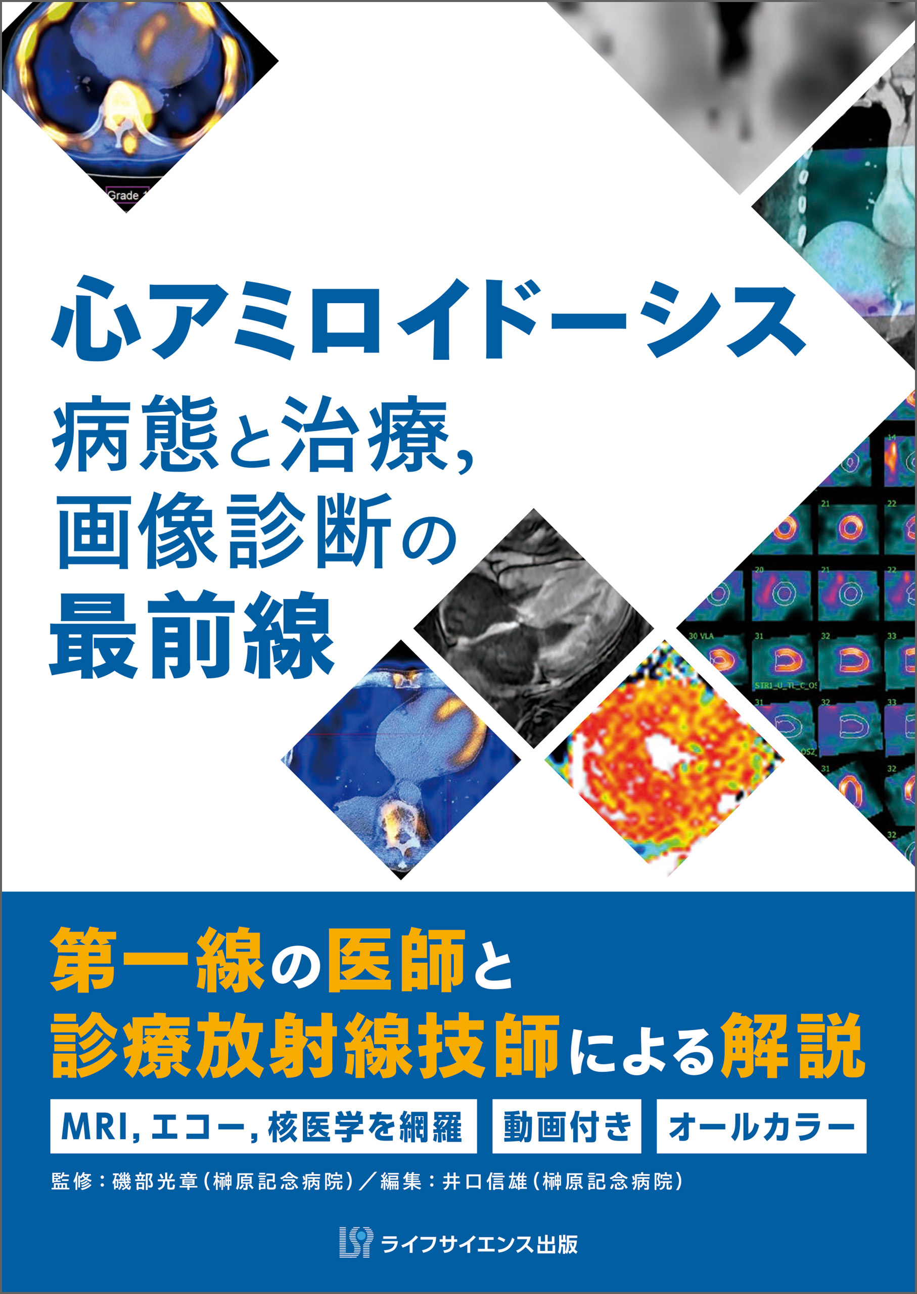心アミロイドーシス　病態と治療，画像診断の最前線